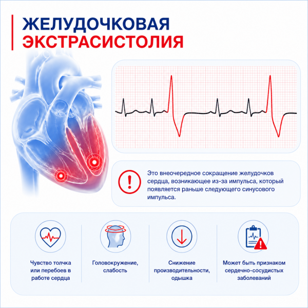 Частая экстрасистолия сердца: что это