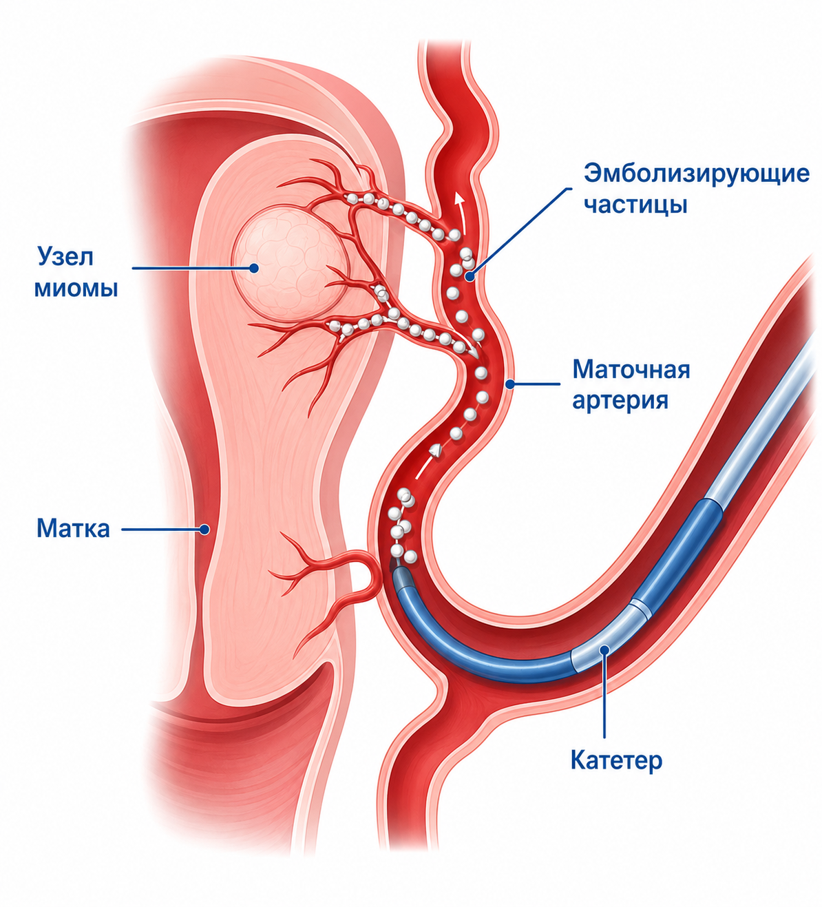 Эмболизация в клинике